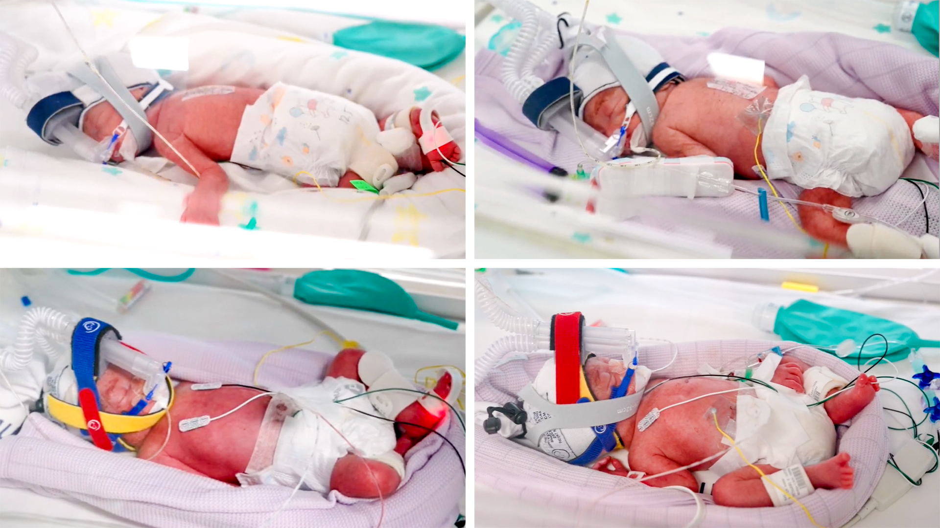 Australia's Tiny Miracle: Identical Quadruplets Arrive Early at 28 Weeks